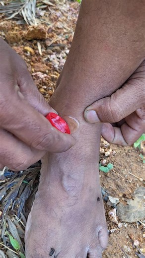 യാത്ര പോകുമ്പോ കാലിൽ കുളയട്ട കടിച്ചാൽ ചെയ്യേണ്ടത് 😲 #leech bite