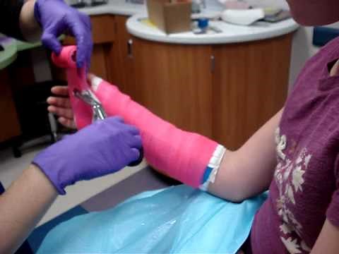 Miciah's first broken arm.