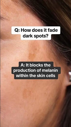 Is Hydroquinone SAFE? The treatment for dark spots | Online Prescription Skincare #musely #skincare