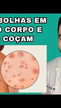 Estou com bolhas cheias de líquido no corpo: será catapora? | Dr. David Campos
