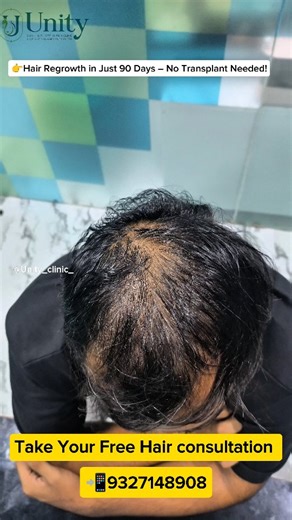 UNITY SKIN | HAIR | ORTHO | PAIN | WEIGHT CLINIC 🏥 | Hair Regrowth in just 90 days- No PRP /No Transplant Needed 🔥✅ 👉🏼Hair Regrowth with Just With Unity Hair regrowth Kit✅ Take Your Free... | Instagram