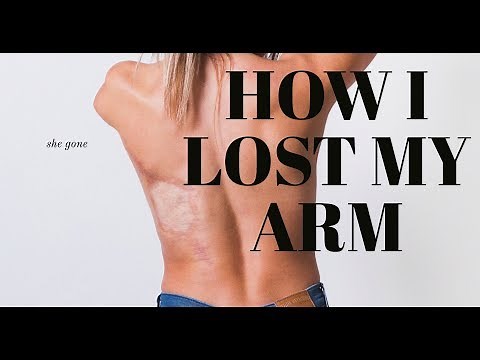 HOW I REALLY LOST MY ARM.