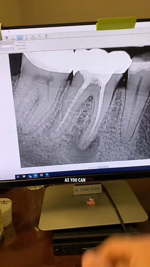 11K views · 92 reactions | #dentistry #dentalschool #hygienists #rootcanaltreatment #Dentists | Advanced Micro-Endodontics | Facebook