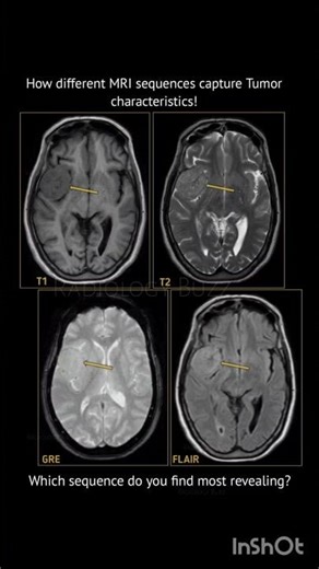 How different MRI sequences highlight tumor characteristics!