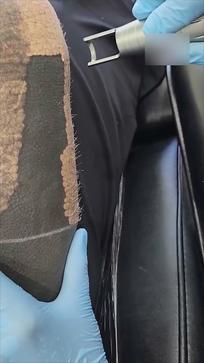 164K views · 205 reactions | Advanced Laser Tattoo Removal | Gang51e June | Facebook