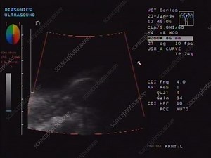 Sexual intercourse, ultrasound footage - Stock Video Clip - K005/7931