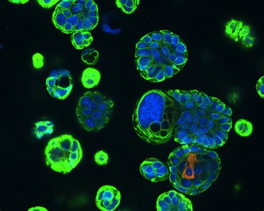 Basal stem-like cells identified as origin of small cell lung cancer in lab models
