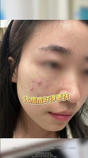 皮肤科医生自用的4支祛痘药膏，改善不同类型的痘痘！#祛痘 #痘痘 #红肿痘 #闭口 #皮肤科好物