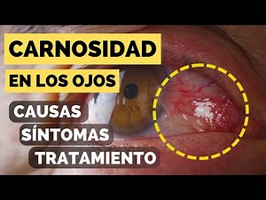 Carnosidad en los Ojos, Causas, Síntomas y Tratamiento Definitivo de Pterigión. Dra Mira Oftalmologo