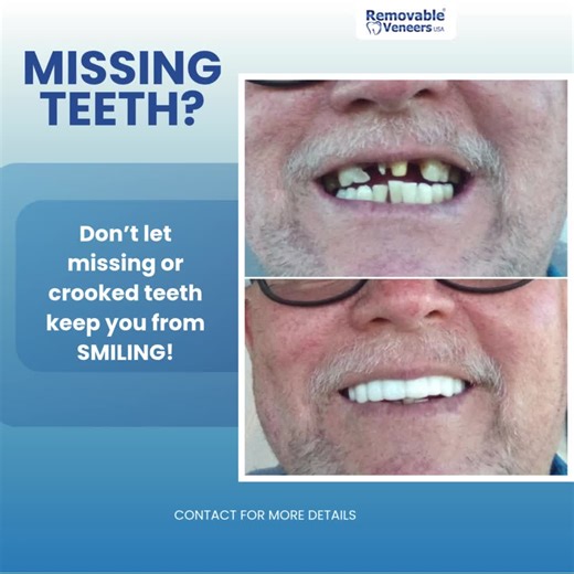 removableveneersusa on TikTok