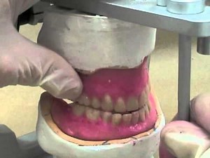 37 Protrusive Contacts Lingualized Occlusion