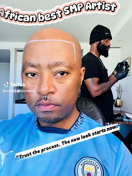 Scalp Micro Pigmentation: Your Solution for Baldness