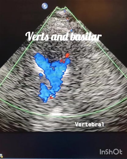 TCD Imaging. #spi #EduTok #fyp #ultrasound #Vascular | Ultra Sound