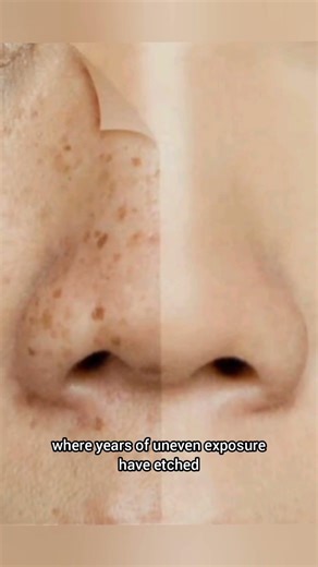 Freckles On Only Half The Face - The Fascinating Stories Behind This Unique Trait