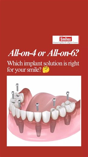 Smilex on Instagram: "All-on-4 or All-on-6? 🤔 Which Dental Implant Is Right for You? At Smilex Dental Care, with more than 30 years of implant experience, Dr. Vijay Deshmukh, the best dentist in Pune, helps you choose the right option based on your needs. All-on-4 Dental Implants – ideal when bone quality is good. All-on-6 Dental Implants – advised when bone is softer or if you’re younger and need teeth for a longer time. 📊 Using advanced 3D scans, we check bone quality and then decide the bes