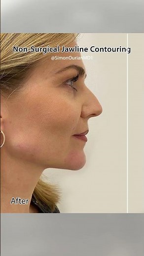 Jawline Contouring by Dr. Simon Ourian at Epione