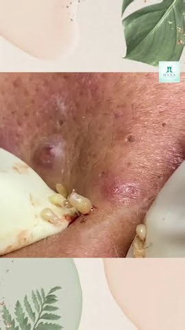 Big Cystic Acne Blackheads Extraction Blackheads & Milia, Whiteheads Removal Pimple Popping #Shorts