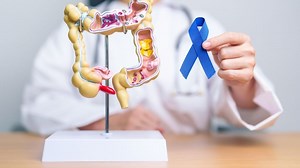 Breaking down colon cancer screening: Tests, benefits and prevention
