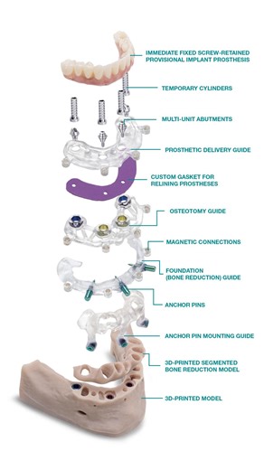 With "stackable" surgical guides, you can reduce bone, place full-arch implants and immediately load with a provisional in one efficient appointment. Get started with 30% off your first case: https://glidewell.dental/3vVERjq | Glidewell Dental