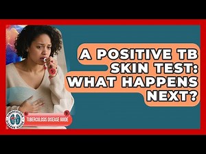 A Positive TB Skin Test: What Happens Next? - Tuberculosis Disease Guide