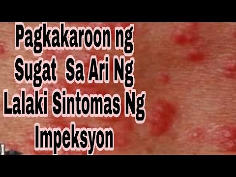 Pamamaga Pamumula at pagkakaroon ng sugat sa ari ng Lalaki#Sintomas#Pangangati