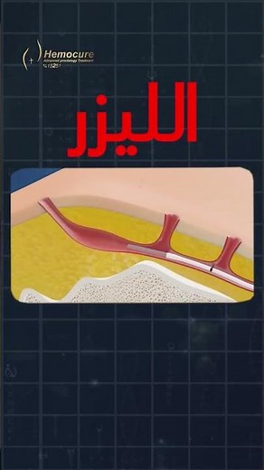 لو عندك ناسور عصعصي وبتخاف من العملية بعد الفيديو ده هتغير رأيك.