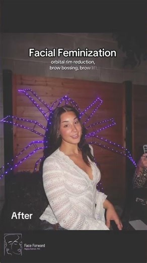 Facial Feminization| Before and After| 2 Years Post Op