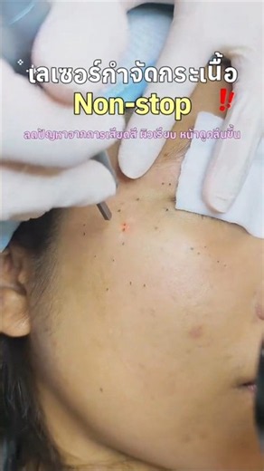 Non-stop skin tag removal laser #laser #skin #skintag #co2laser