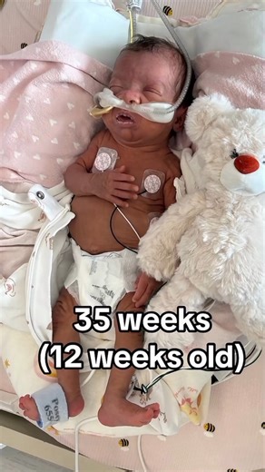 35 Weeks Premature baby life journey🥺😢 #prematurebaby #35weeksbaby #shortvideo #shorts #shortsfeed