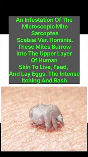 Stop the Itch! How to Kill Scabies Fast 🕷️ #skincare #itchyskin