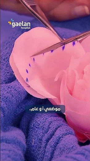 Labiaplasty at #gaelanhospital gaelanhospital