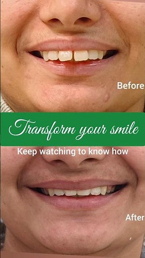 Teeth look out? Watch this! #braces #smilemakeover