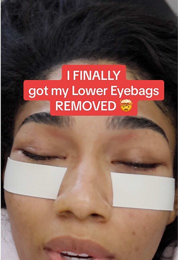 Raw Experience of Lower Eyebags Removal Surgery