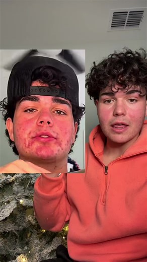 Only thing that has worked for me #acne #acnetreatment #acneproneskin | acne