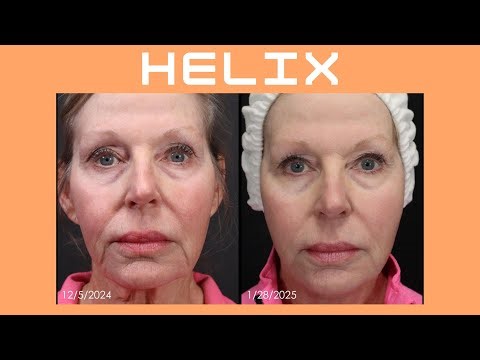 Unlock Youthful Skin with Helix Laser: The Game-Changer You’ve Been Waiting For!