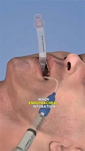 How LMA Insertion Procedure (3D Animation) Laryngeal Mask Airway Insertion is used to keep the airway open during anesthesia. A soft mask-like device is placed through the mouth and positioned over the Larynx. This allows oxygen and anesthetic gases to flow into the lungs. #lma #airwaymanagement #anesthesia #medicalanimation #3danimation
