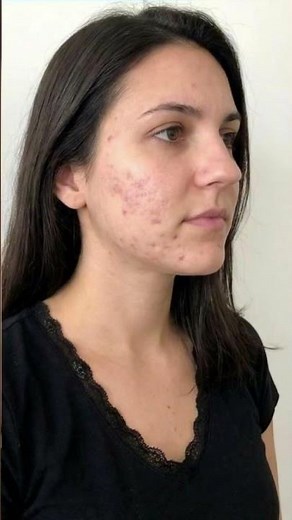 Laser Frax : Peau lisse et régénérée | My Laser