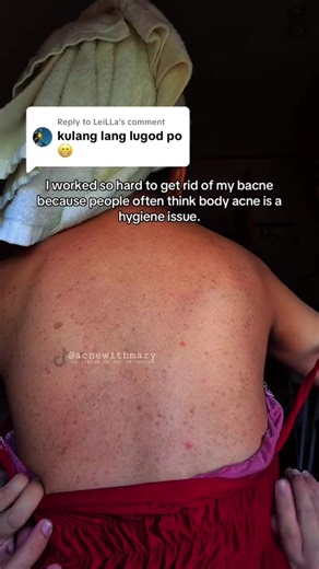 Effective Bacne Treatment for Clear Skin Progress