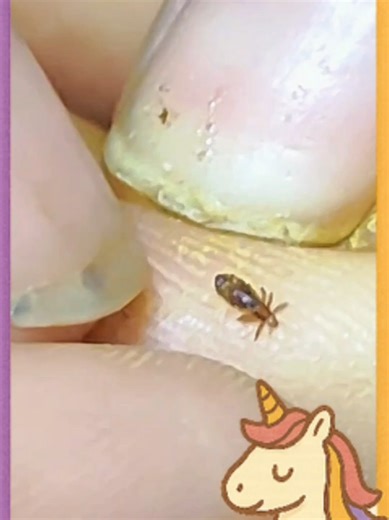 Effective Lice Removal Techniques for Parents