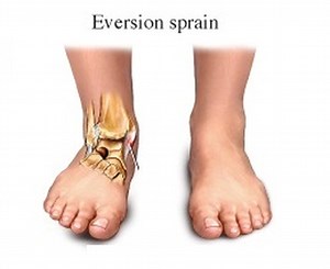 How Does an Eversion Ankle Sprain Happen?