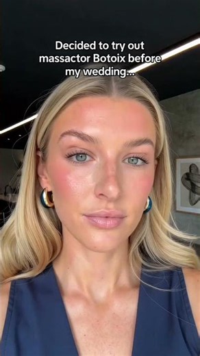 Try this masseter Botox for your wedding?