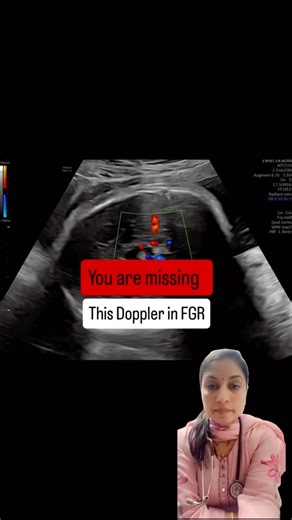 “Doppler in Fetal Growth Restriction (FGR) Explained | Umbilical Artery, MCA & DV