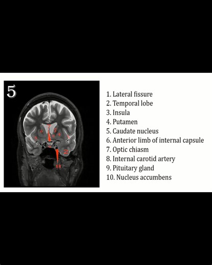 17K views · 165 reactions | MRI of Brain Coronal Anatomy | CT Scan and MRI study | Facebook