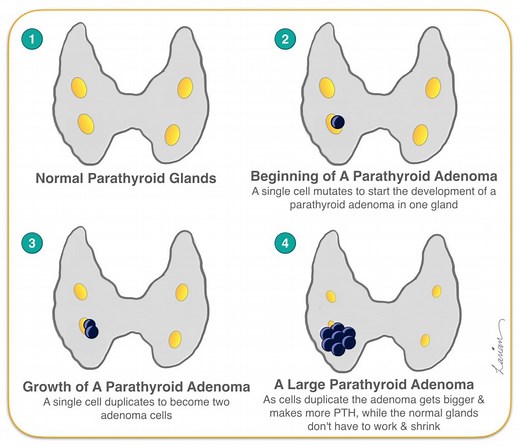 Intraoperative Parathyroid Hormone (PTH) Testing | Dr. Babak Larian
