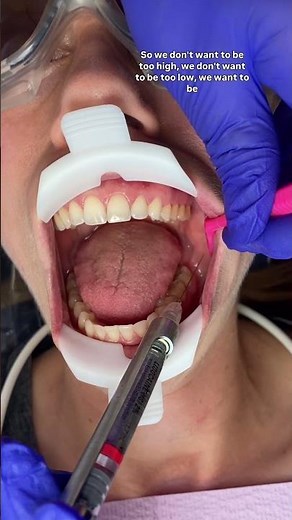 Long Buccal Injection #dentist