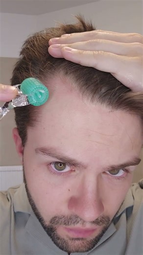 Regrowing Hair with DERMAROLLER & MINOXIDIL (Step-by-Step)