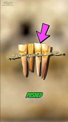 What Braces REALLY Do to Teeth 🦷