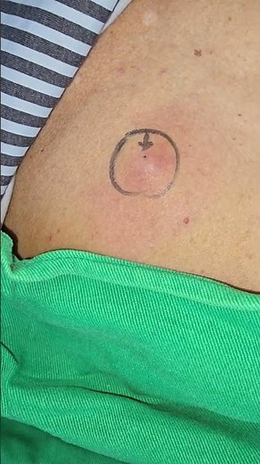 Infected Sebaceous cyst