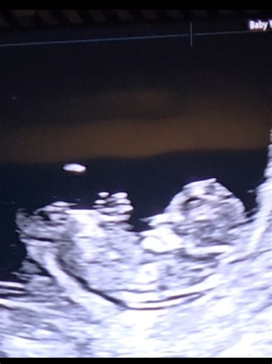 At 11 weeks pregnant your baby is the size of a small lime. Your embryo is now considered a fetus. The heart is now fully formed, the brain is growing quickly, the facial features are coming into place, and your baby is making small movements (tho you cant feel them yet). #sandiegobaby #babyultrasound #pregnancyultrasound #sandiegomom