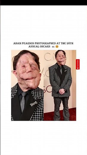 Adam Pearson’s journey with neurofibromatosis and Hollywood success😊 #shorts